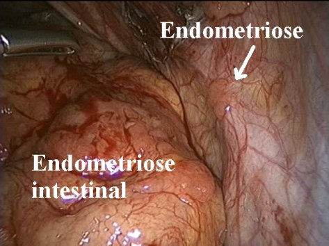 endometriose_intestinal_ozimo_gama