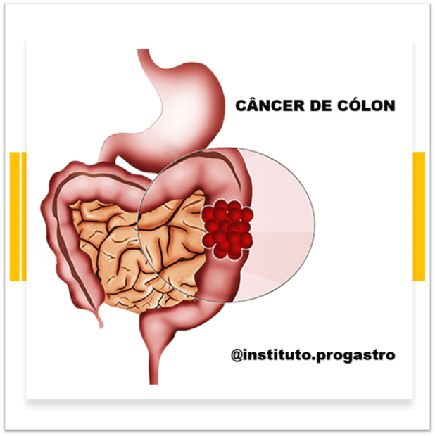 Como Prevenir o CÂNCER DE CÓLON (Intestino&nbsp;Grosso)?