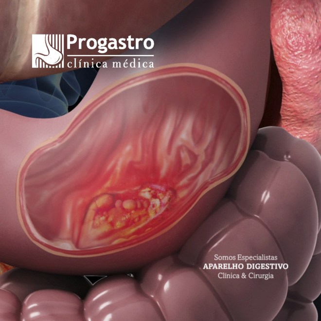 Setembro Rubi: Mês de Conscientização sobre o Câncer&nbsp;Gástrico