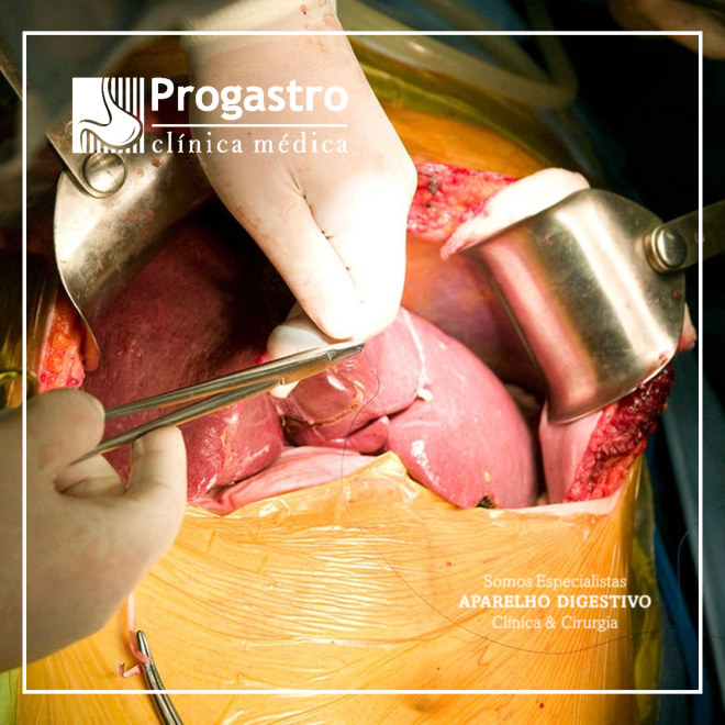 Transplante Hepático na Insuficiência Hepática&nbsp;Aguda